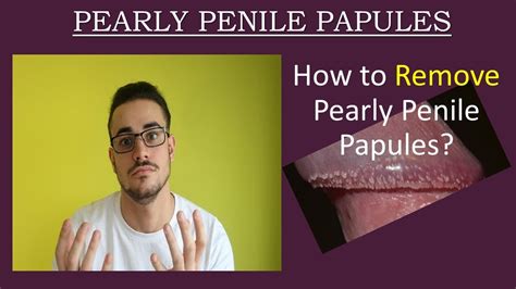 papule perlee penis|Pearly Penile Papules: Causes and Treatment